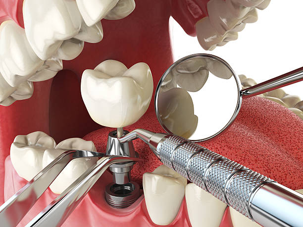 Best Emergency Dental Services for Seniors in Palm Springs, FL